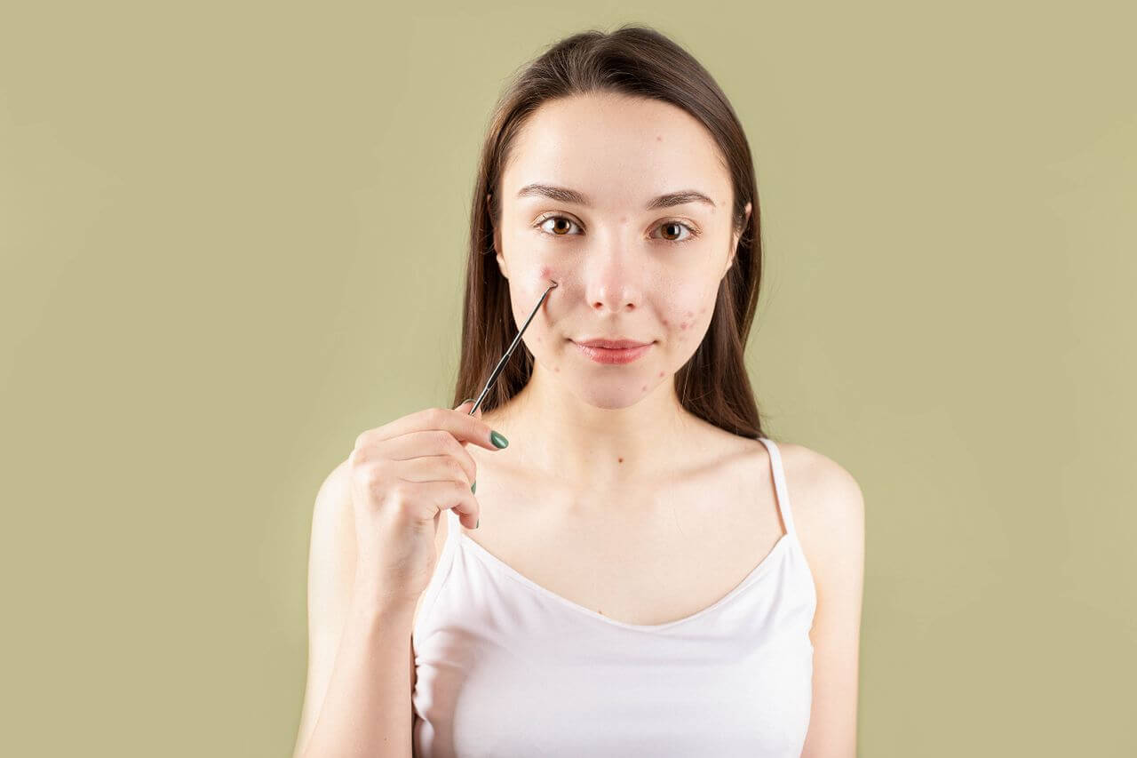 Acne adulta dopo i 25 anni: cause e skincare routine
