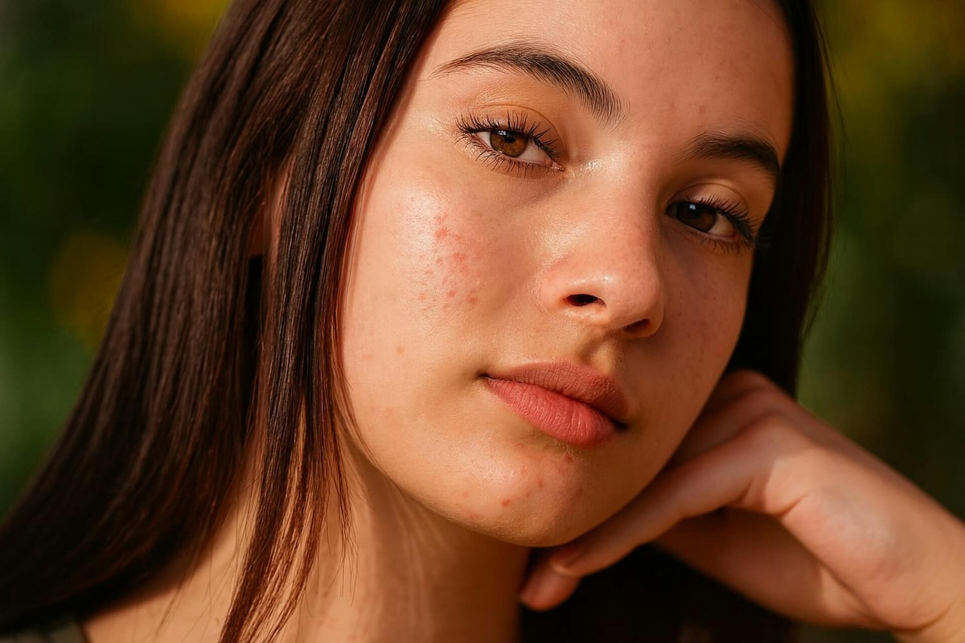 Cicatrici da acne: rimedi e skincare per attenuarle