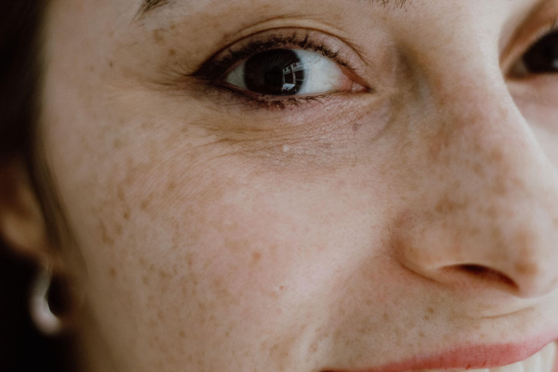 Lentigo senili: cause, prevenzione e skincare per le macchie