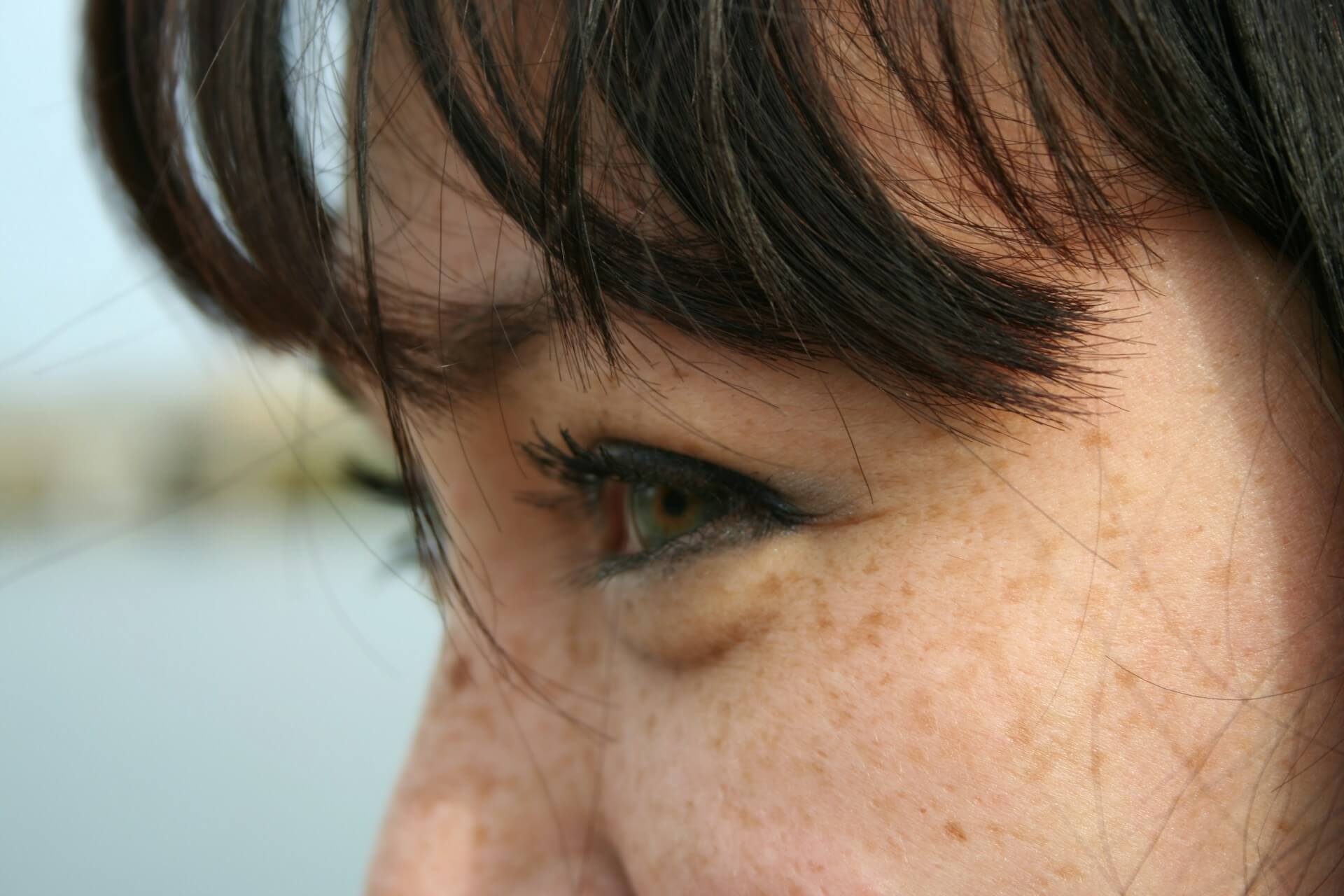 Come eliminare le macchie viso da sole: rimedi e prevenzione