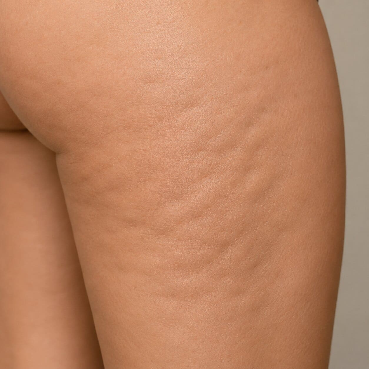 Cellulite